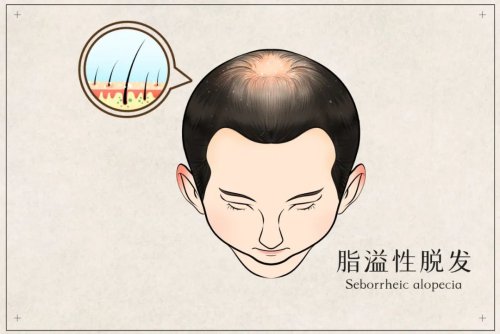 脂溢性脫發(fā)