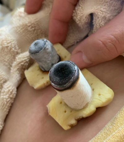 艾灸